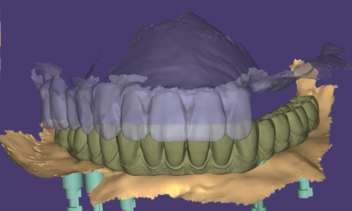 Full-Mouth Restoration Anatomic Design