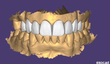 3D Smile Design as Index for Aesthetic prostheses