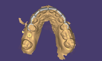 3D Smile Design as Index for Aesthetic prostheses
