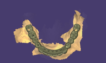 Full-Mouth Restoration Anatomic Design