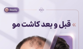 طراحی کاور ریلز کلینیک کاشت مو