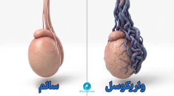 فایل ارایه مبحث واریکوسل ( ارولوژی پزشکی)