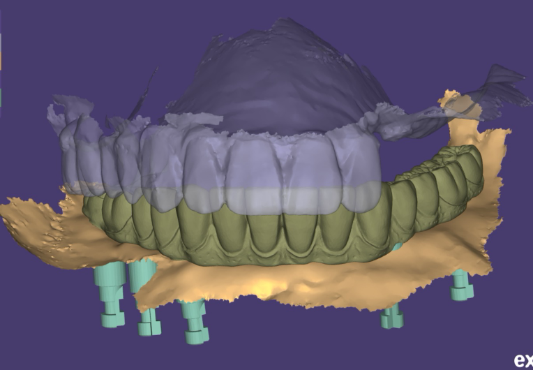 Full-Mouth Restoration Anatomic Design