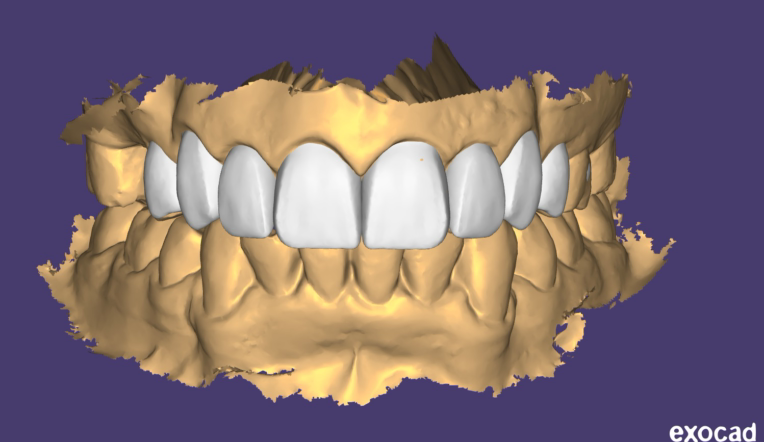 3D Smile Design as Index for Aesthetic prostheses
