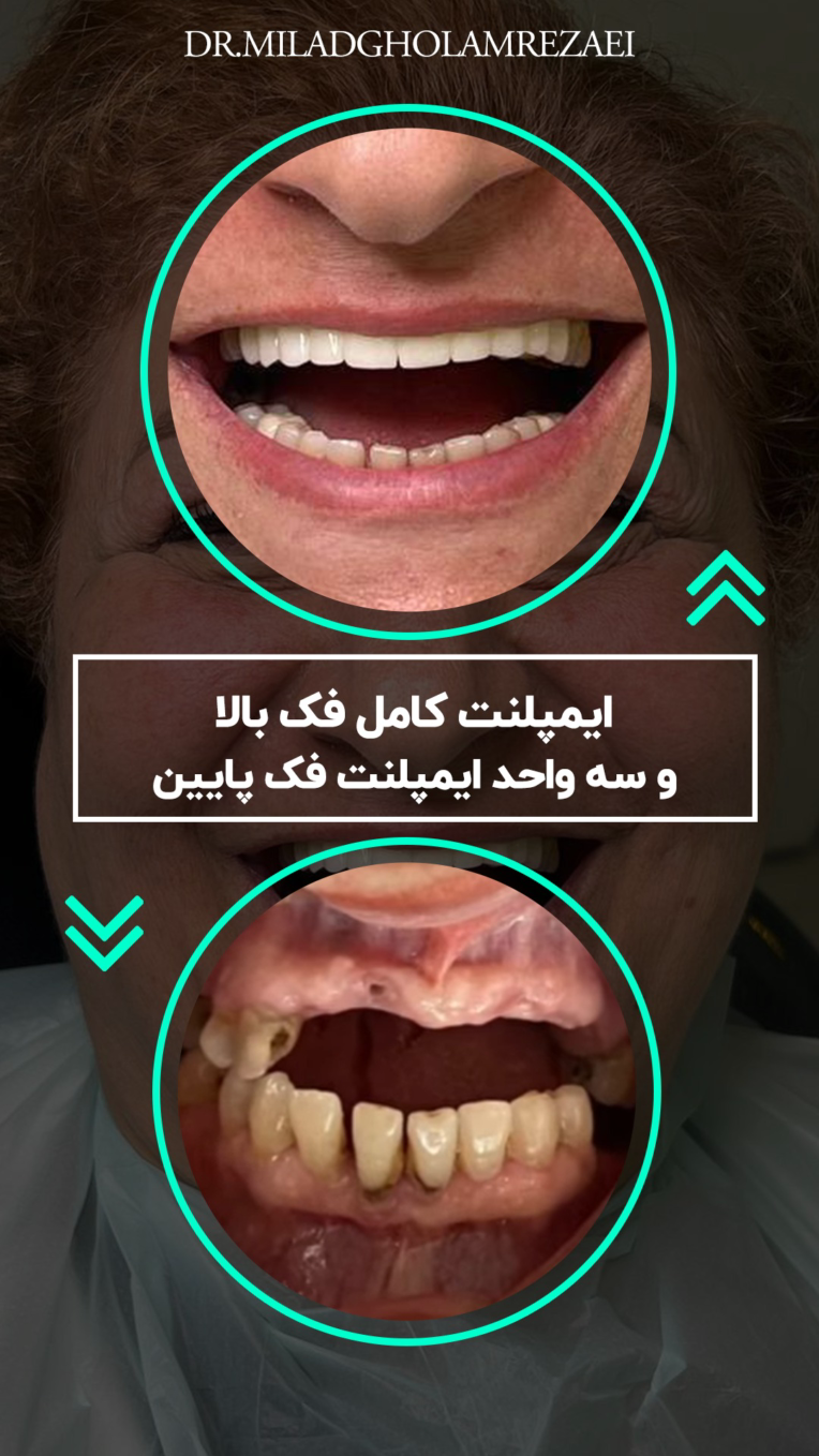 طراحی استوری قبل و بعد دندان پزشکی