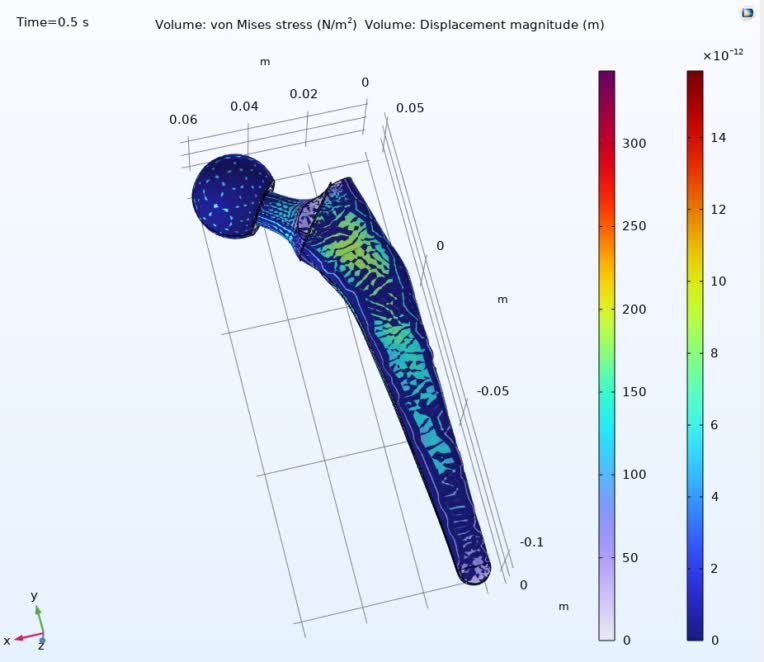 hip implant analysis مفصل ران، مهندسی پزشکی