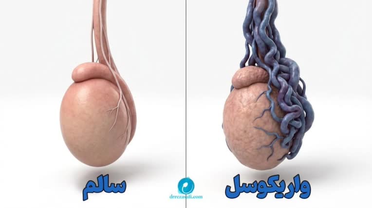 فایل ارایه مبحث واریکوسل ( ارولوژی پزشکی)