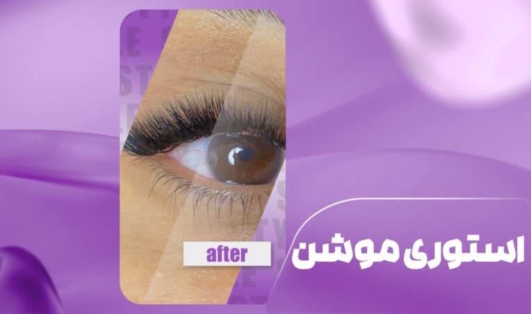 استوری موشن قبل و بعد کاشت مژه