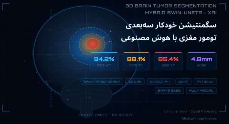 سگمنتیشن خودکار سه‌بعدی تومور مغزی در تصاویر MRI چندمودالیتی با استفاده از معماری هیبرید Swin Transformer-CNN و هوش مصنوعی قابل تفسیر
